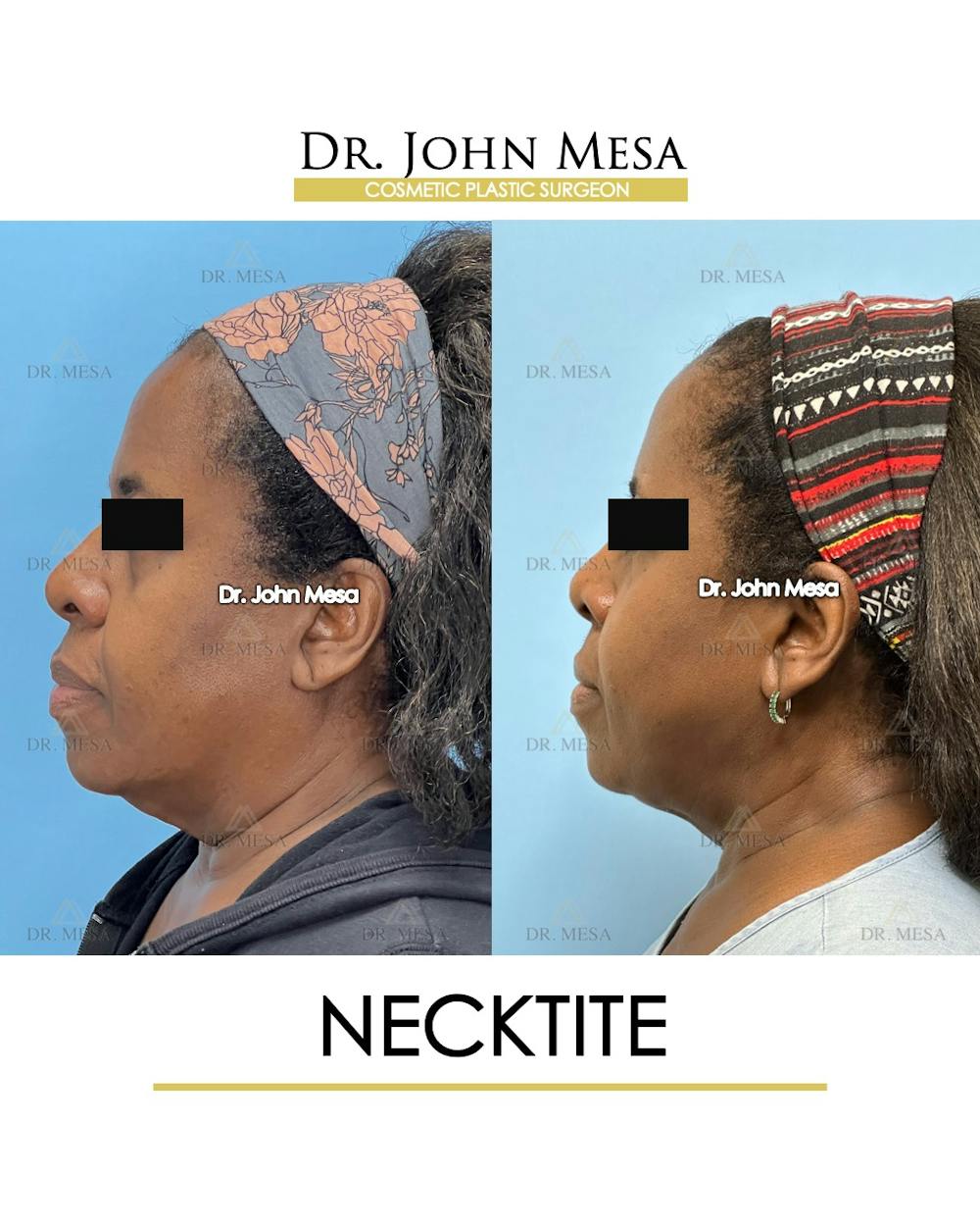 NeckTite Before & After Gallery - Patient 817200 - Image 5