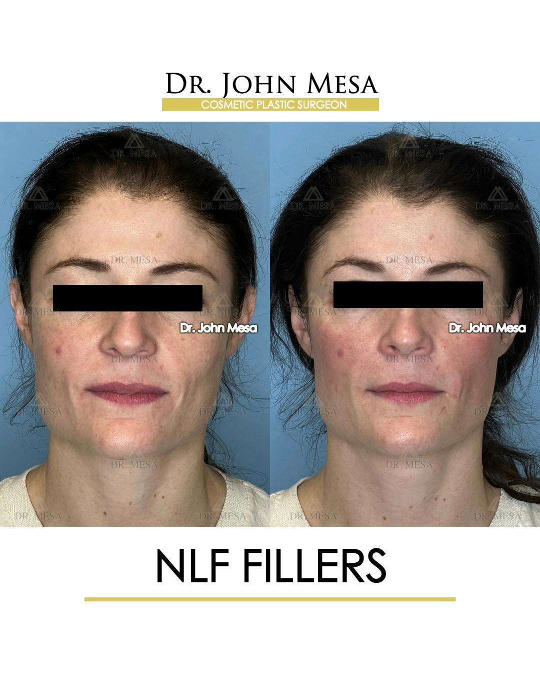 NLF Fillers Before & After Gallery - Patient 241525 - Image 1