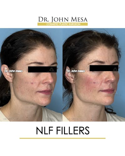 NLF Fillers Before & After Gallery - Patient 241525 - Image 2