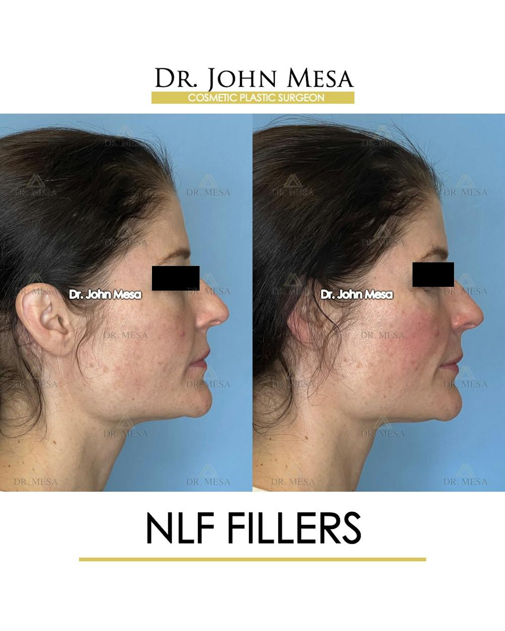 NLF Fillers Before & After Gallery - Patient 241525 - Image 3