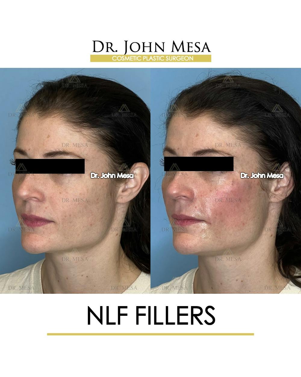 NLF Fillers Before & After Gallery - Patient 241525 - Image 4