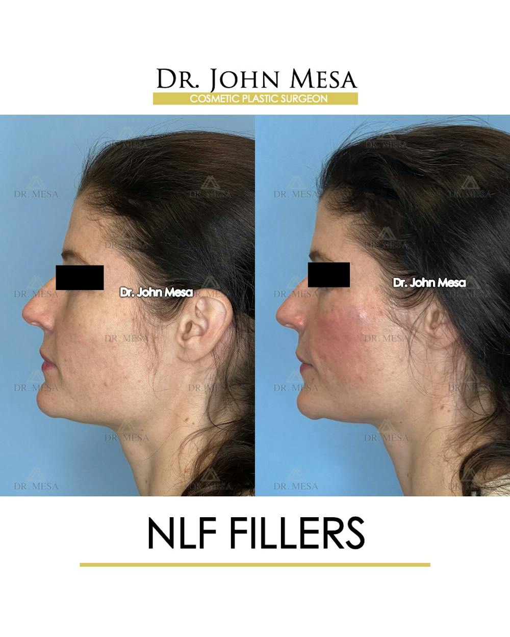 NLF Fillers Before & After Gallery - Patient 241525 - Image 5