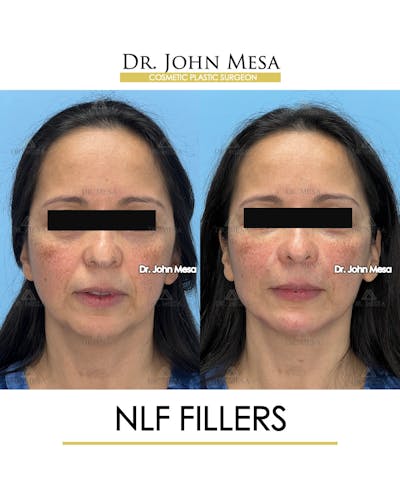 NLF Fillers Before & After Gallery - Patient 396277 - Image 1
