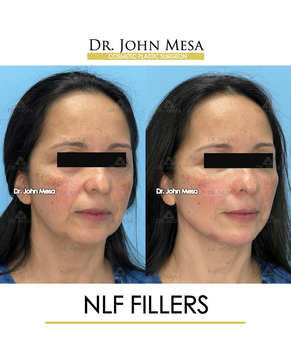 NLF Fillers Before & After Gallery - Patient 396277 - Image 2