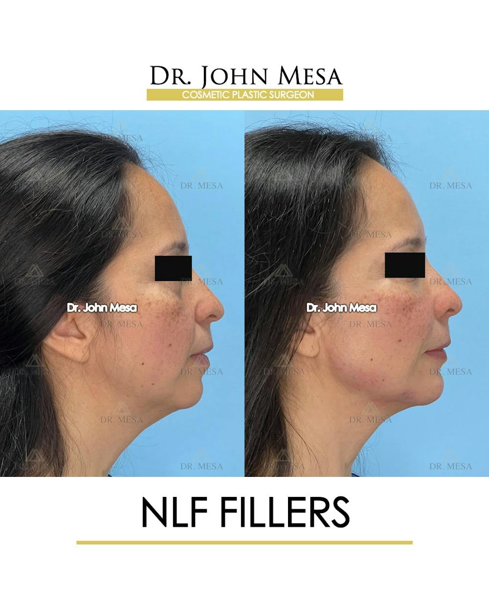 NLF Fillers Before & After Gallery - Patient 396277 - Image 3