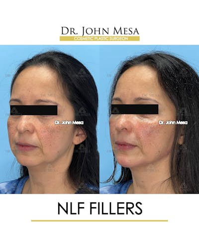 NLF Fillers Before & After Gallery - Patient 396277 - Image 4