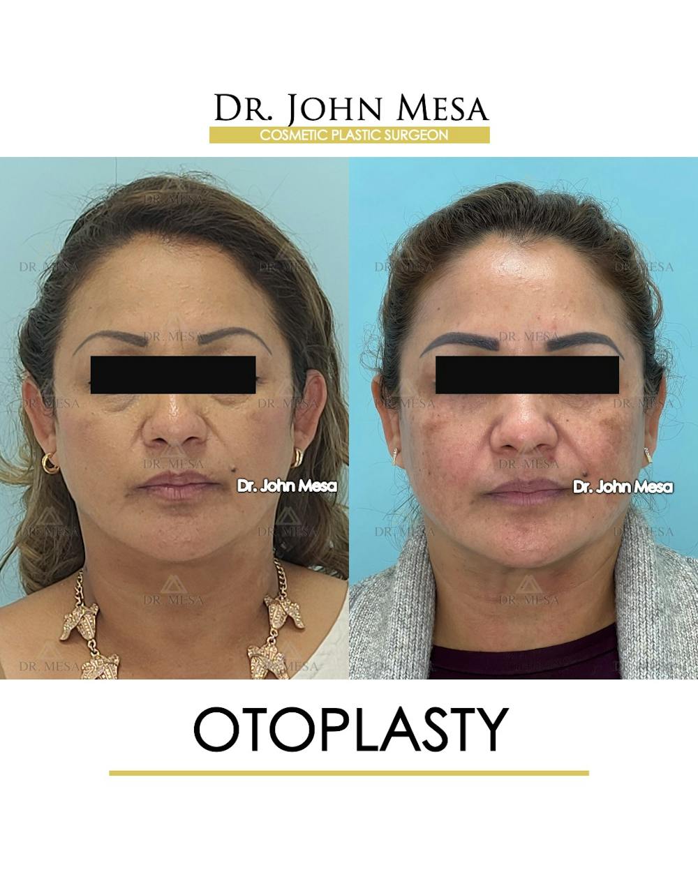Otoplasty Before & After Gallery - Patient 217078 - Image 2