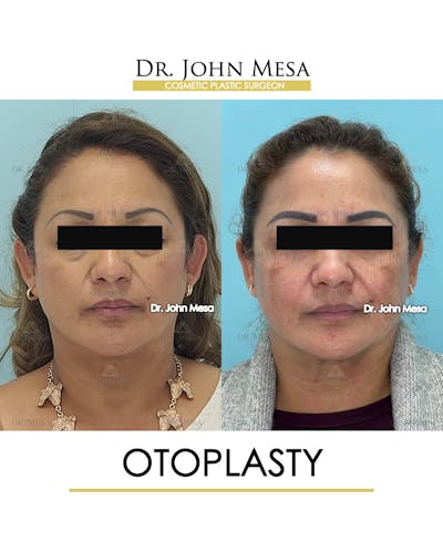Otoplasty Before & After Gallery - Patient 217078 - Image 2