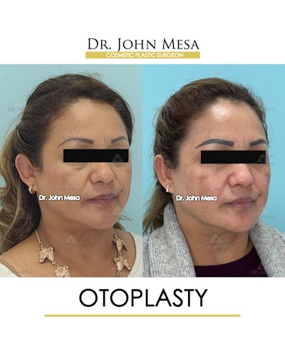 Otoplasty Before & After Gallery - Patient 217078 - Image 1