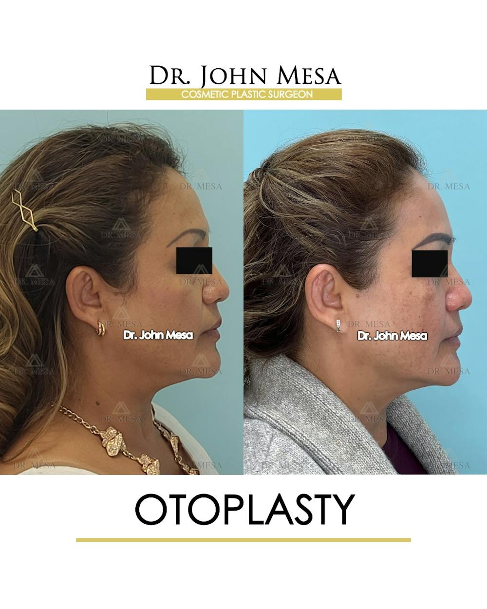 Otoplasty Before & After Gallery - Patient 217078 - Image 3