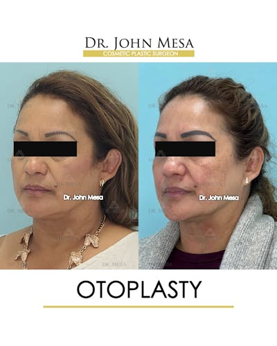 Otoplasty Before & After Gallery - Patient 217078 - Image 4