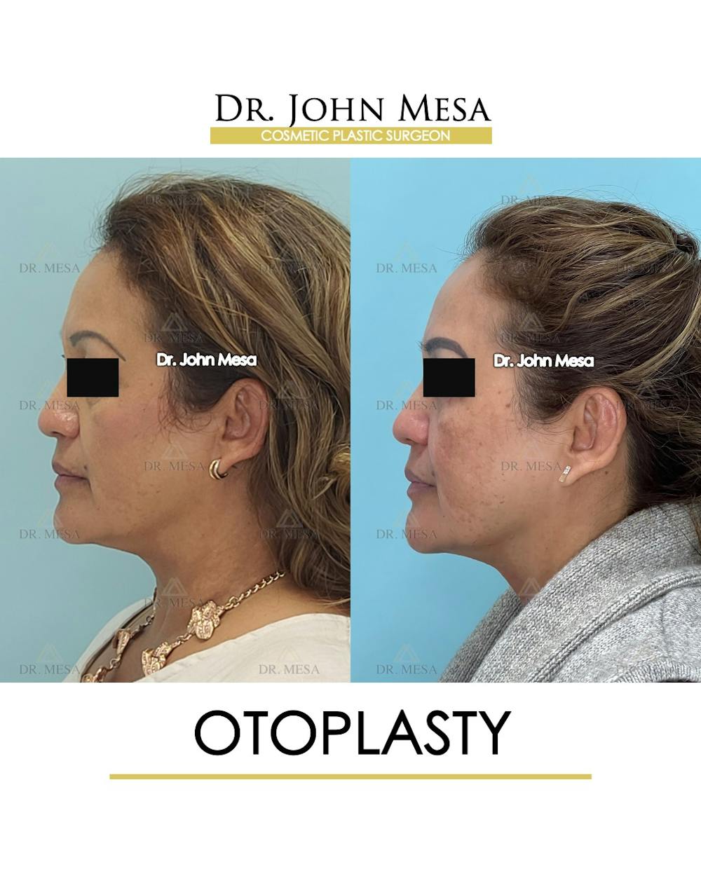 Otoplasty Before & After Gallery - Patient 217078 - Image 5