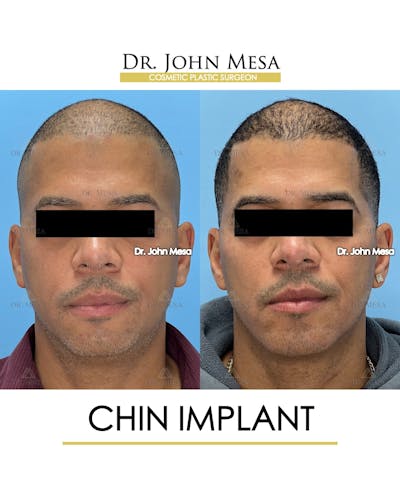 Chin Implant Before & After Gallery - Patient 367598 - Image 1