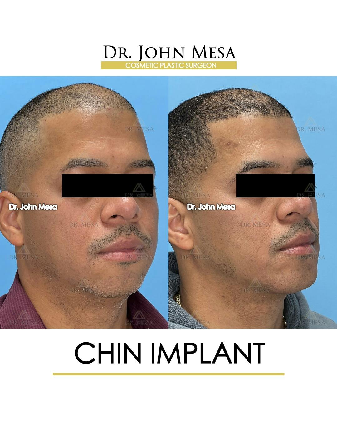 Chin Implant Before & After Gallery - Patient 367598 - Image 2