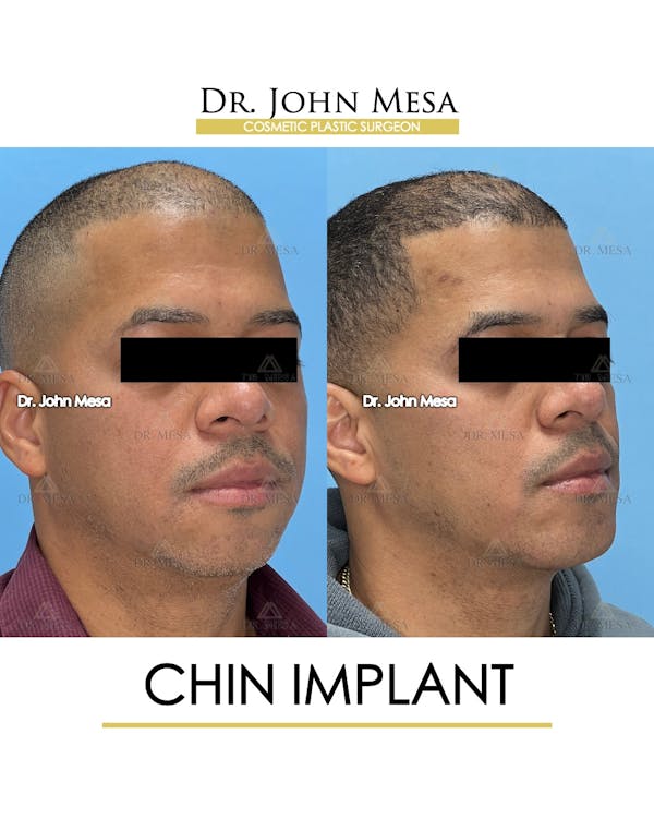 Chin Implant Before & After Gallery - Patient 367598 - Image 2