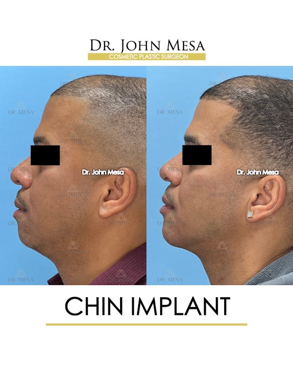 Chin Implant Before & After Gallery - Patient 367598 - Image 3