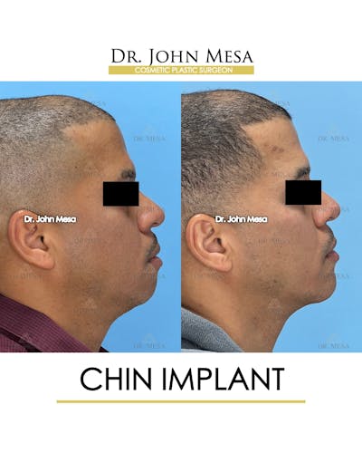 Chin Implant Before & After Gallery - Patient 367598 - Image 4