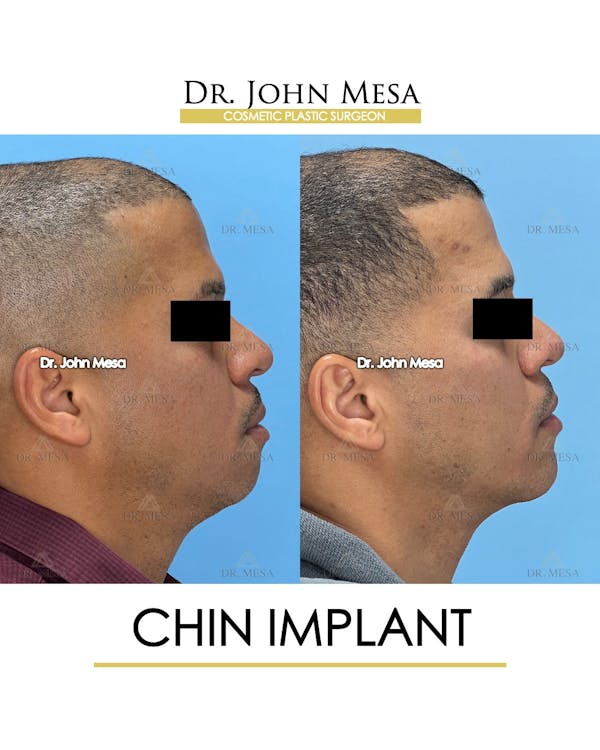 Chin Implant Before & After Gallery - Patient 367598 - Image 4