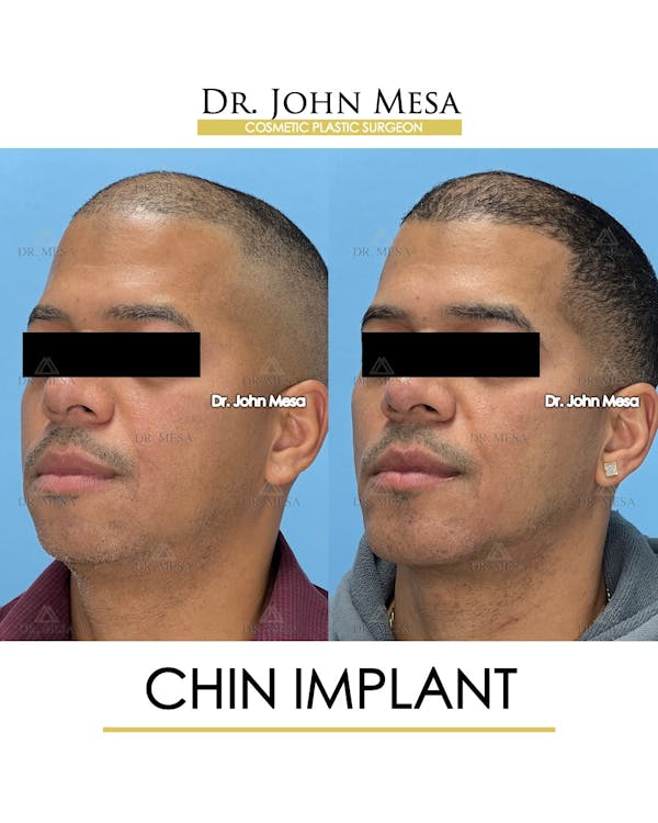 Chin Implant Before & After Gallery - Patient 367598 - Image 5