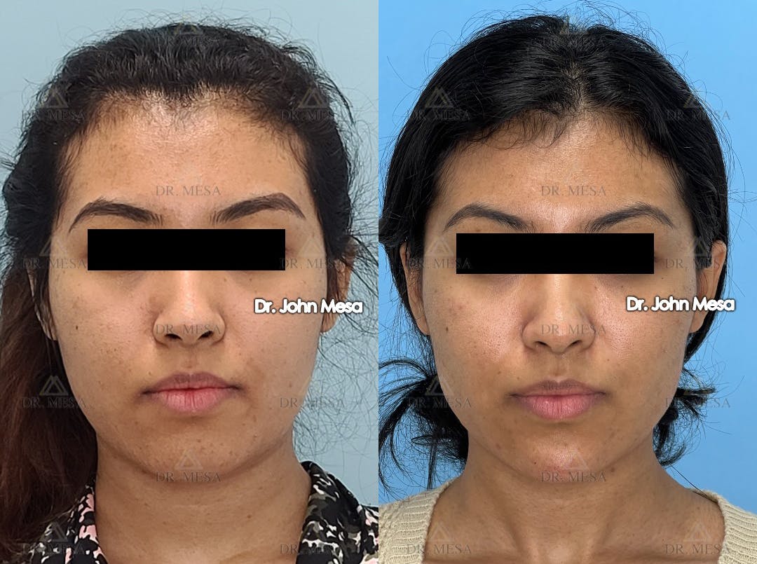 Buccal Fat Pad Removal Before & After Gallery - Patient 194916 - Image 1