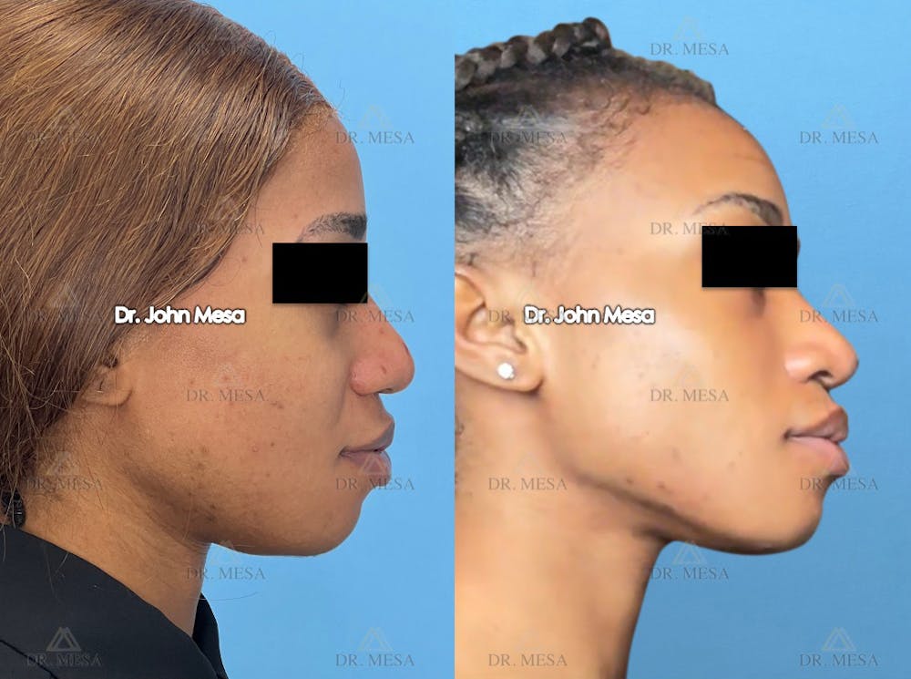 Chin Liposuction Before & After Gallery - Patient 148735140 - Image 1