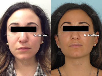 Buccal Fat Pad Removal Before & After Gallery - Patient 13823388 - Image 1
