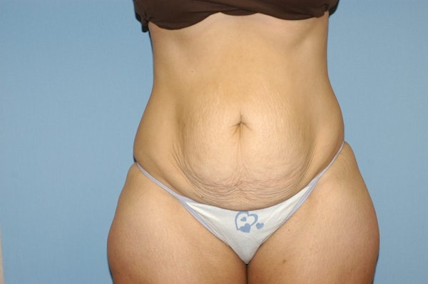 Before and After Abdominoplasty in Long Island