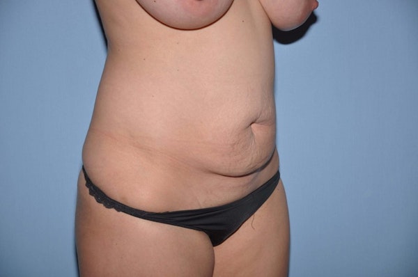 Tummy Tuck Before & After Gallery - Patient 6389345 - Image 3