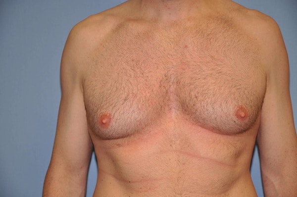 Long Island Gynecomastia Surgery Before and After