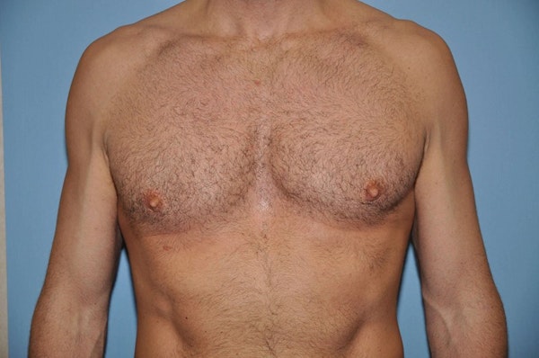 Long Island Gynecomastia Surgery Before and After