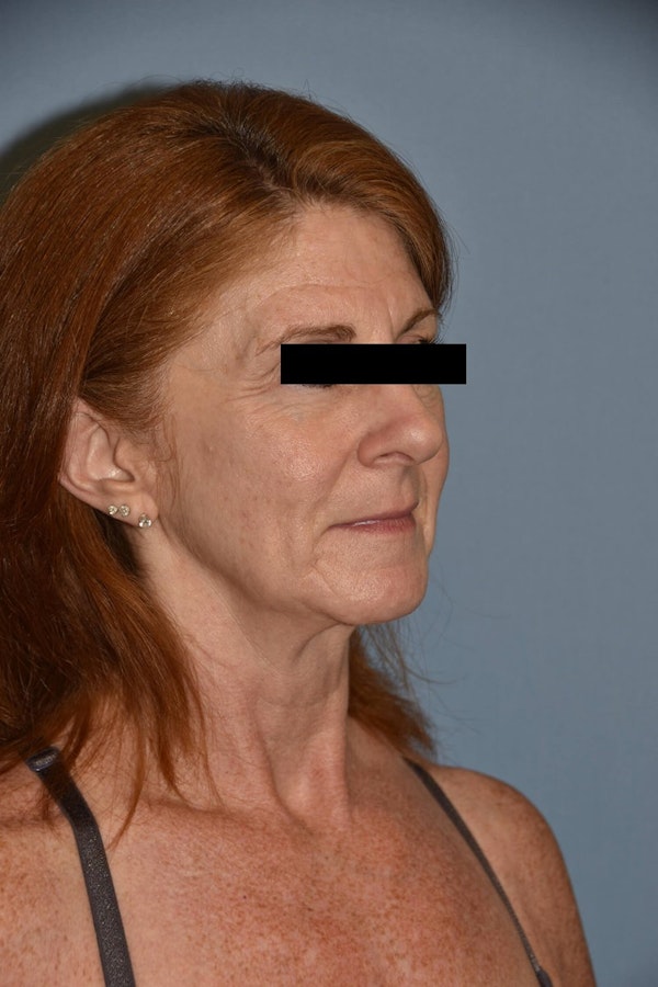 Facial Fat Grafting