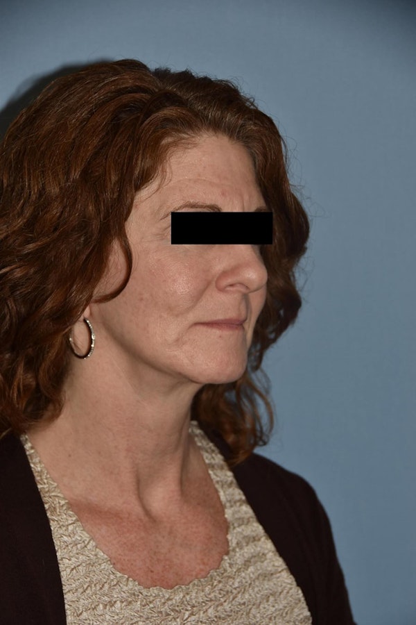 Facial Fat Grafting