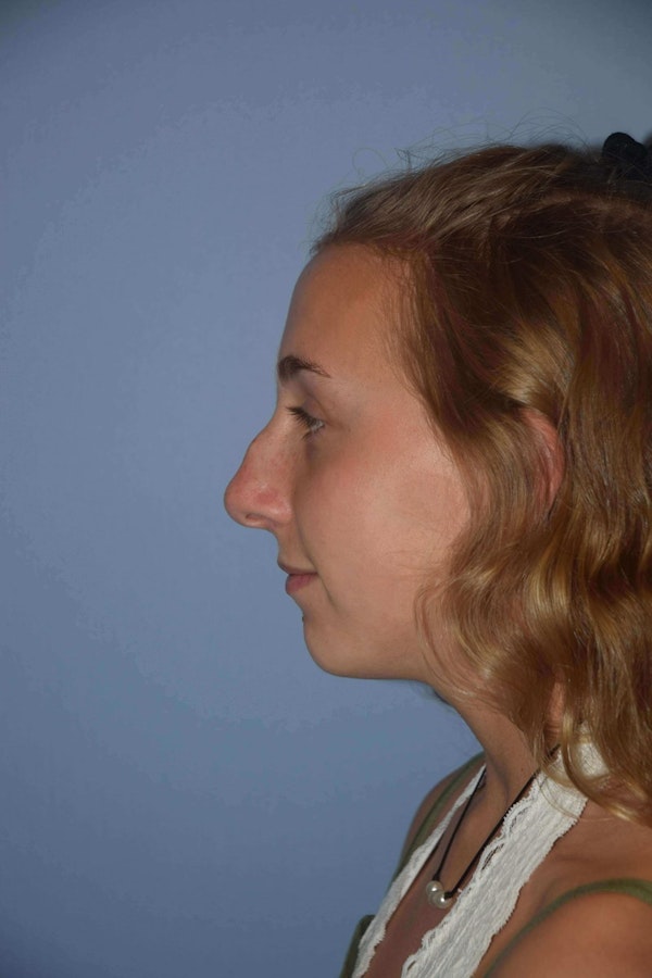 Nonsurgical Rhinoplasty