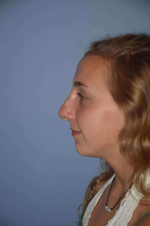 Nonsurgical Rhinoplasty