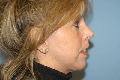 Chin Augmentation Before & After Gallery - Patient 6389455 - Image 2
