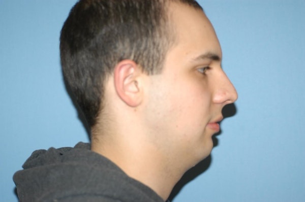 Chin Augmentation