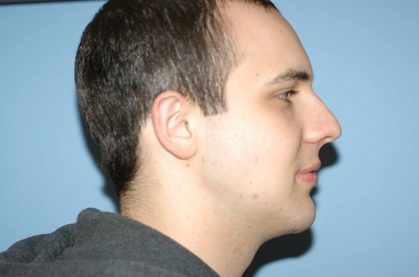 Chin Augmentation