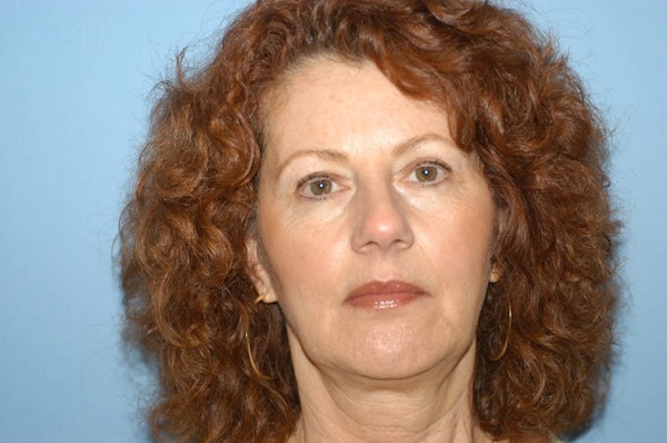 Chin Augmentation Before & After Gallery - Patient 6389460 - Image 4