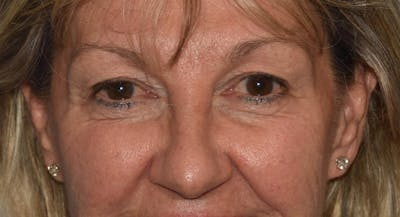Eyelid Lift Before & After Gallery - Patient 6389462 - Image 1
