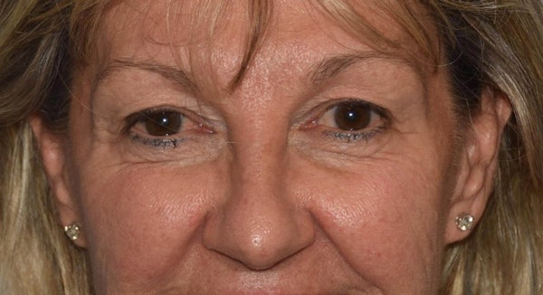 Eyelid Lift Before & After Gallery - Patient 6389462 - Image 1