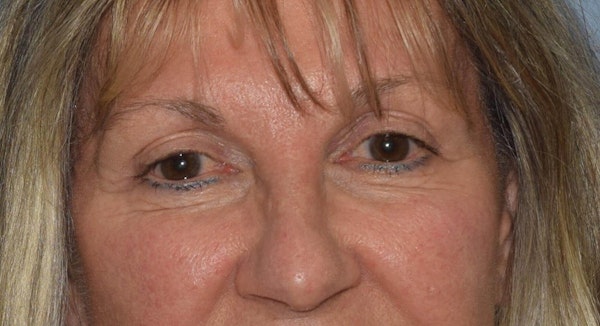 Eyelid Lift Before & After Gallery - Patient 6389462 - Image 2