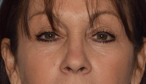 Before and After Blepharoplasty in Long Island