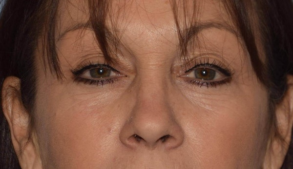 Eyelid Lift Before & After Gallery - Patient 6389463 - Image 1