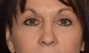 Before and After Blepharoplasty in Long Island