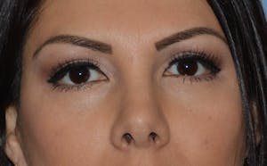 Before and After Blepharoplasty in Long Island