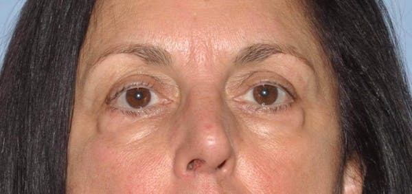 Eyelid Lift Before & After Gallery - Patient 6389473 - Image 1