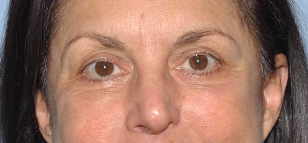 Eyelid Lift Before & After Gallery - Patient 6389473 - Image 2
