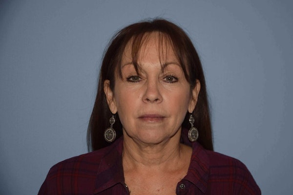 Facelift