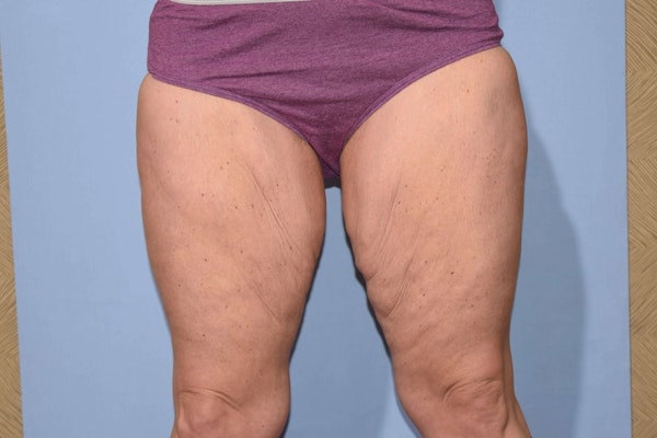 Long Island Thigh Lift patient before and after