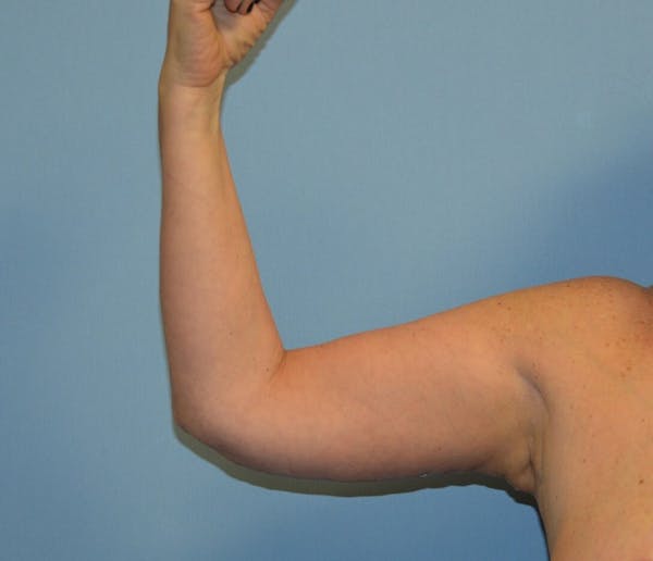 Arm Lift Before & After Gallery - Patient 6389552 - Image 2
